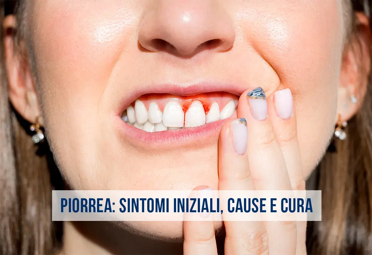 Gengive sanguinanti, un sintomo iniziale della piorrea. Scopri le cause e come curarla.