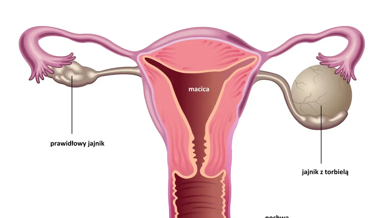 Anatomia kobieca: macica, jajowody, jajnik prawidłowy i jajnik z torbielą.