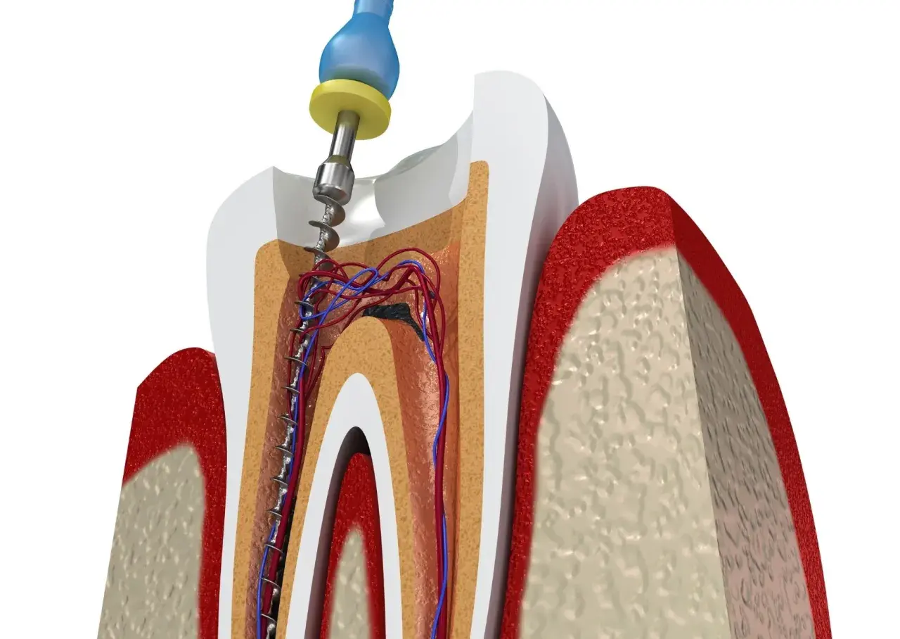 Instrumento dental limpia conducto radicular afectado por caries avanzada. Se aprecian vasos sanguíneos y nervios.