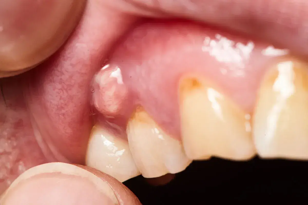 Gengiva gonfia con una piccola protuberanza, possibile fistola gengivale su dente incapsulato.