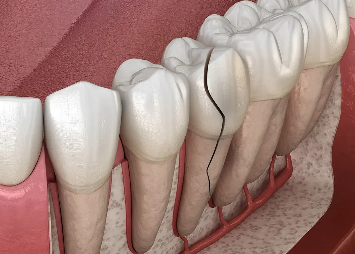 Dente con evidente crepe smalto, che si estende dalla corona alla radice, mostrando la vulnerabilità della struttura dentale.