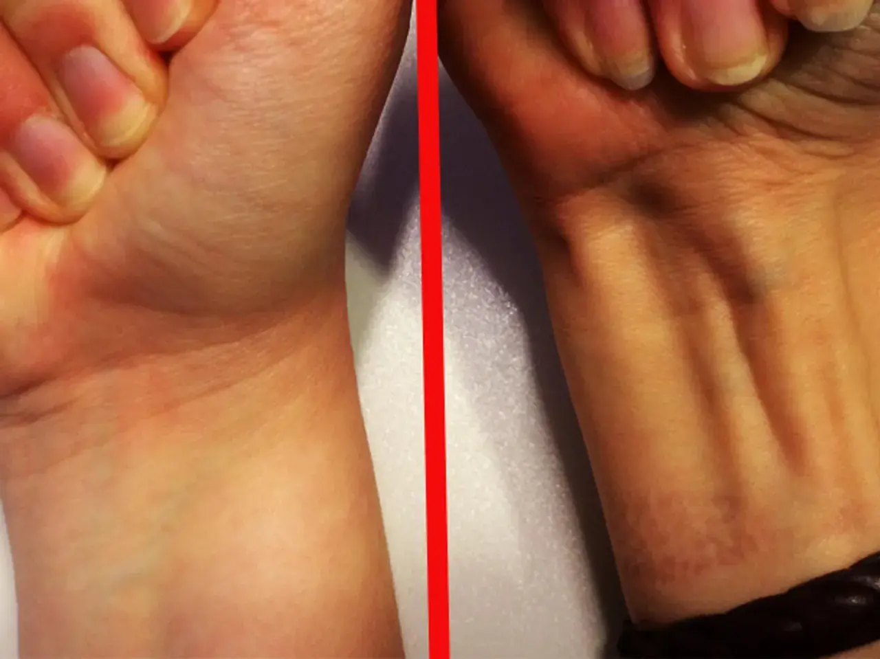 Vergleich zweier Handgelenke: Links glatt, rechts mit sichtbaren Sehnen, darunter der palmaris longus.