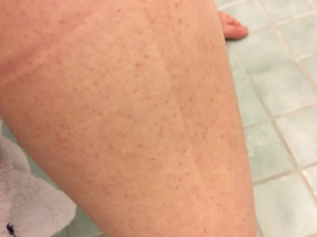 Närbild på hud med små prickar, liknande jordgubbsben. En bit av en vit handduk syns i bakgrunden.