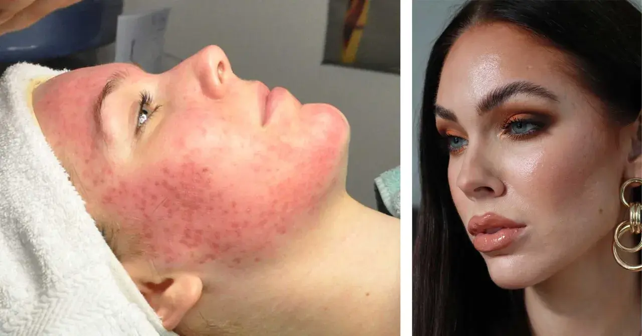 Före och efter: Ansikte med svår cystisk akne förvandlas till klar hud.