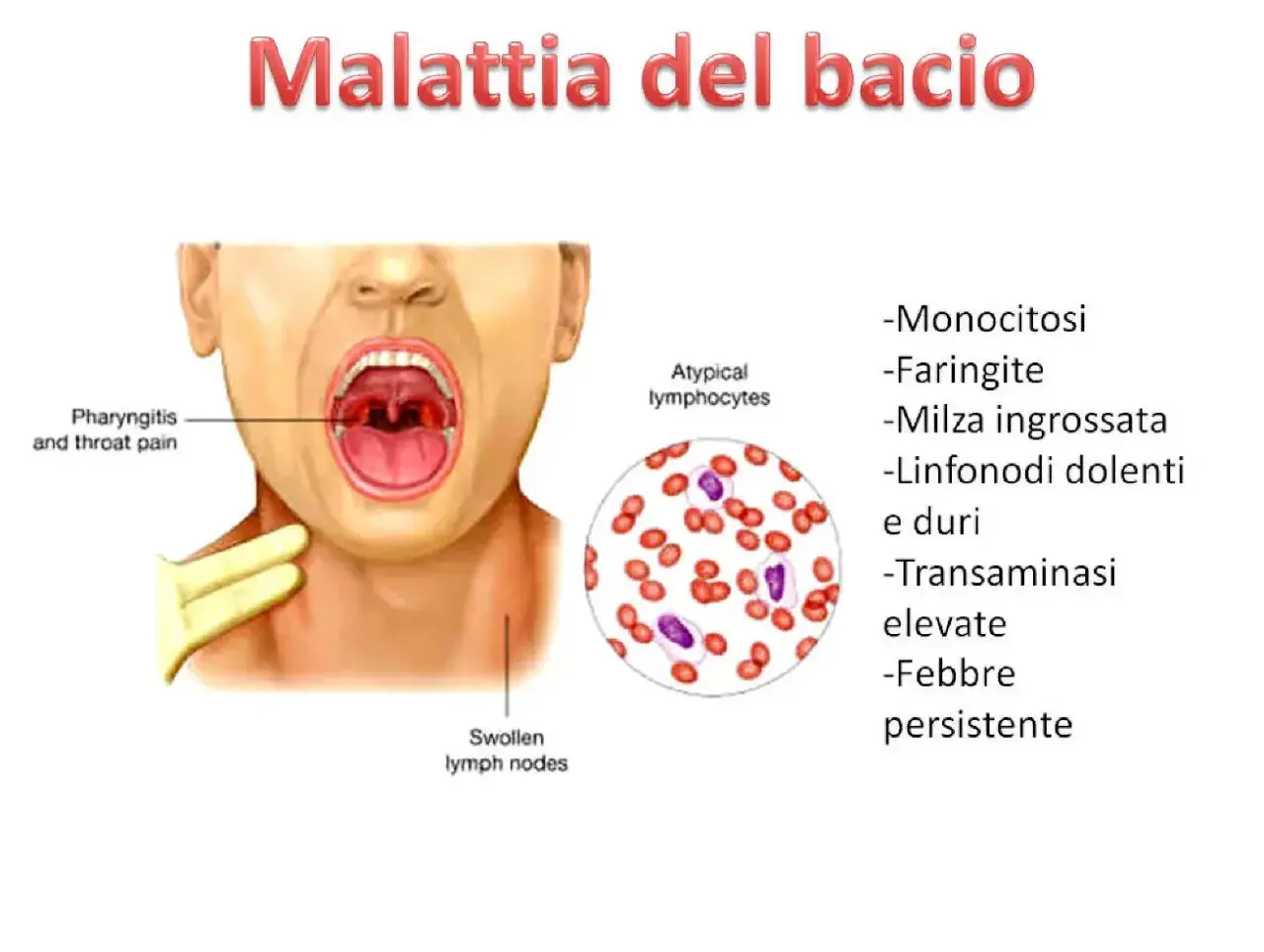 Malattia del bacio: sintomi come faringite, linfonodi dolenti, febbre persistente e monocitosi.