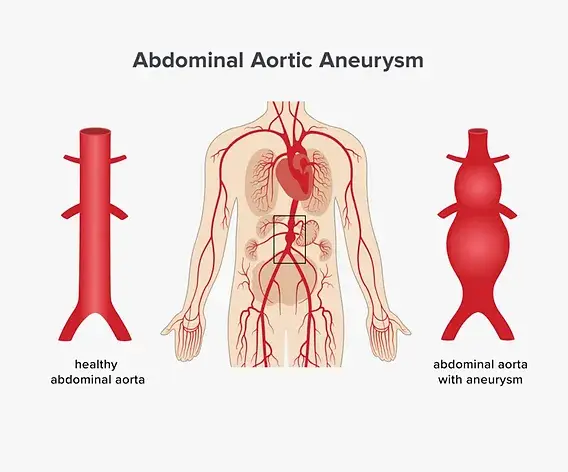 Aneurysma Symptome Bauch: Warnsignale, die Sie nicht ignorieren sollten
