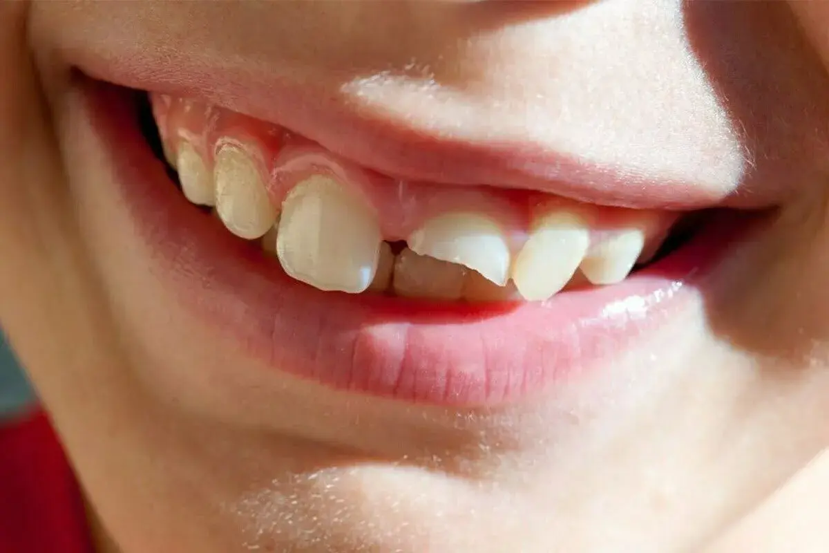 ¡Ay, se me ha caído un diente! ¿Qué hago? La sonrisa de un niño con un diente roto y un espacio vacío.