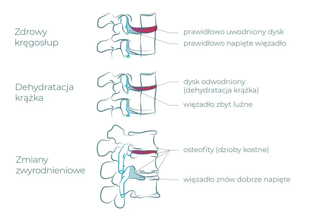 Ilustracja pokazuje postęp zwyrodnienia kręgosłupa lędźwiowego: od zdrowego dysku, przez jego odwodnienie, po zmiany zwyrodnieniowe z osteofitami.