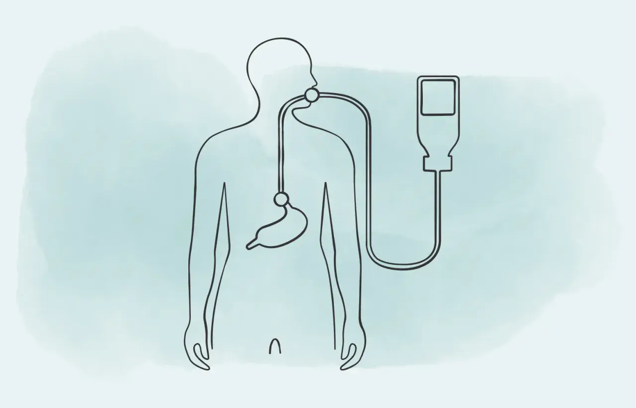 Stilisierte Darstellung eines Körpers mit Magensonde und Infusionsbeutel. Die Frage "wie lange kann man mit einer Magensonde leben" wird visuell thematisiert.