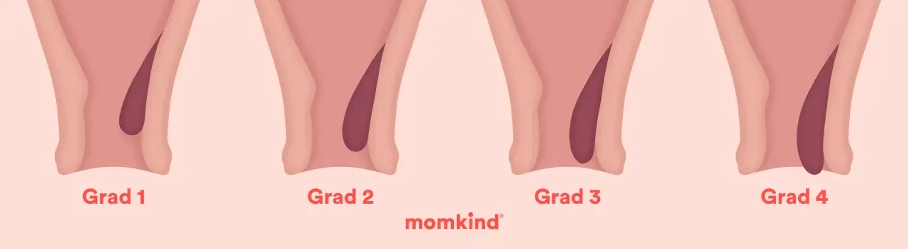 Illustration visar grader av hemorrojder, från grad 1 till 4. Vanligt vid graviditet.