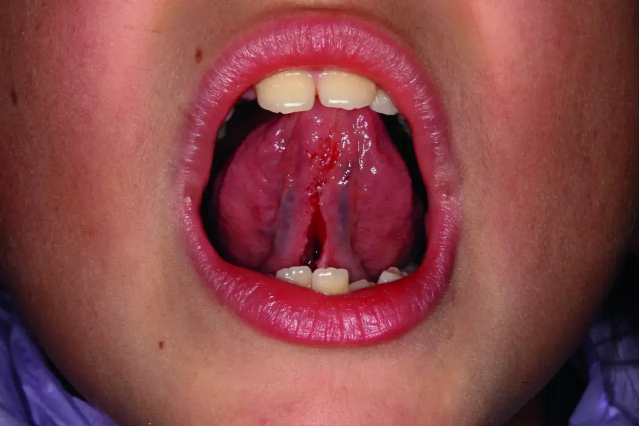 Bocca aperta con lingua che mostra un frenulo linguale corto e lacerato, con sanguinamento.