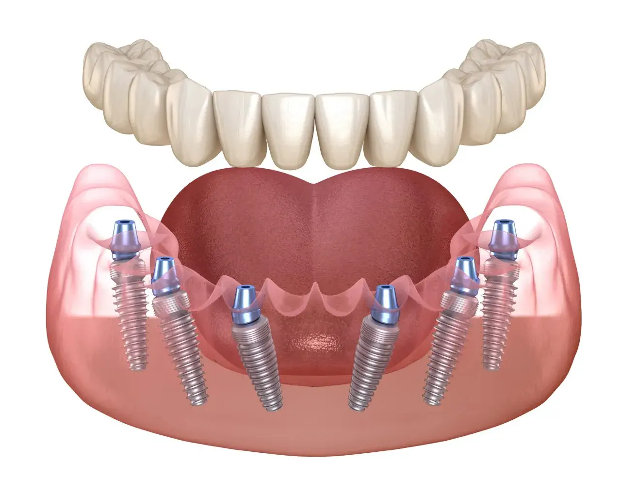 Implantes dentales en la mandíbula inferior, mostrando la integración del injerto óseo dental. Problemas de encía y hueso pueden afectar la estabilidad.