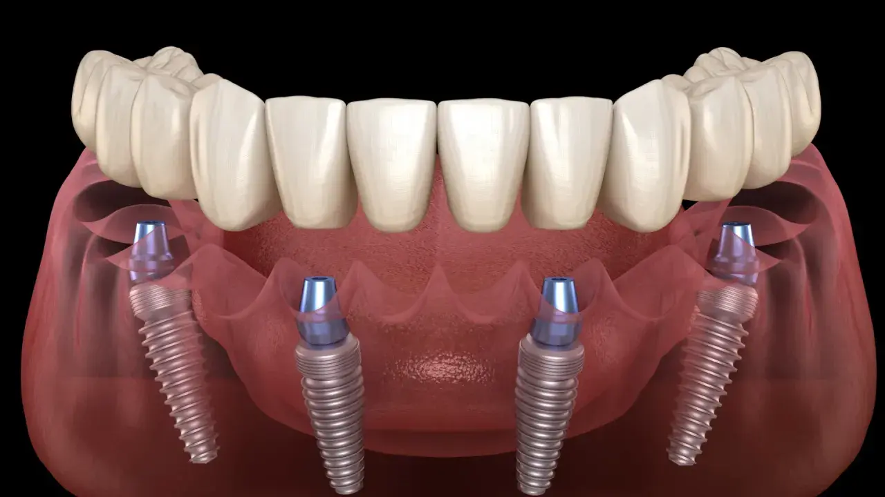 Arcata dentale fissa su quattro impianti dentali, una soluzione moderna per un sorriso completo.