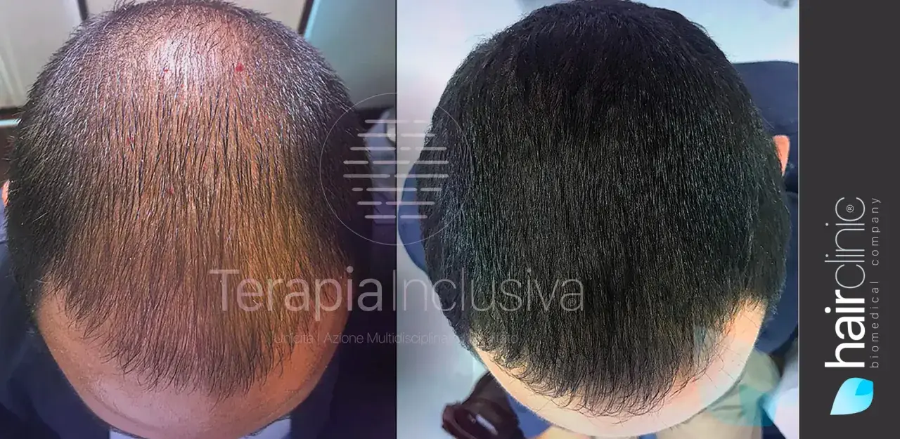 Prima e dopo: un uomo mostra come far ricrescere i capelli con un trattamento che ha ridensificato la chioma, eliminando la calvizie.