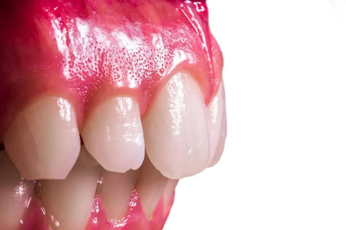 Primer plano de encías inflamadas y dientes, mostrando un posible epulis dental.