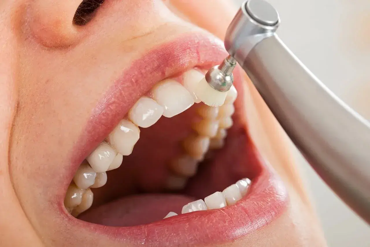 La pulizia dei denti con uno strumento rotante per un sorriso smagliante.