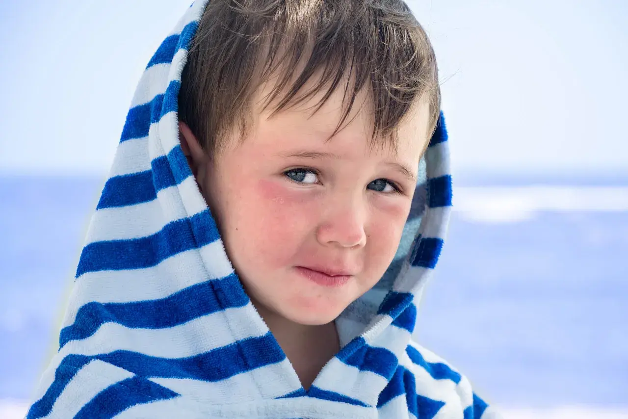 Bambino con guance arrossate, forse per la dermatite da sabbia, avvolto in un accappatoio a righe blu e bianche.