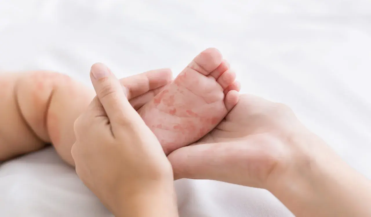 Pieds et mains rouges d'un bébé, possiblement liés au traitement du pied-main-bouche.