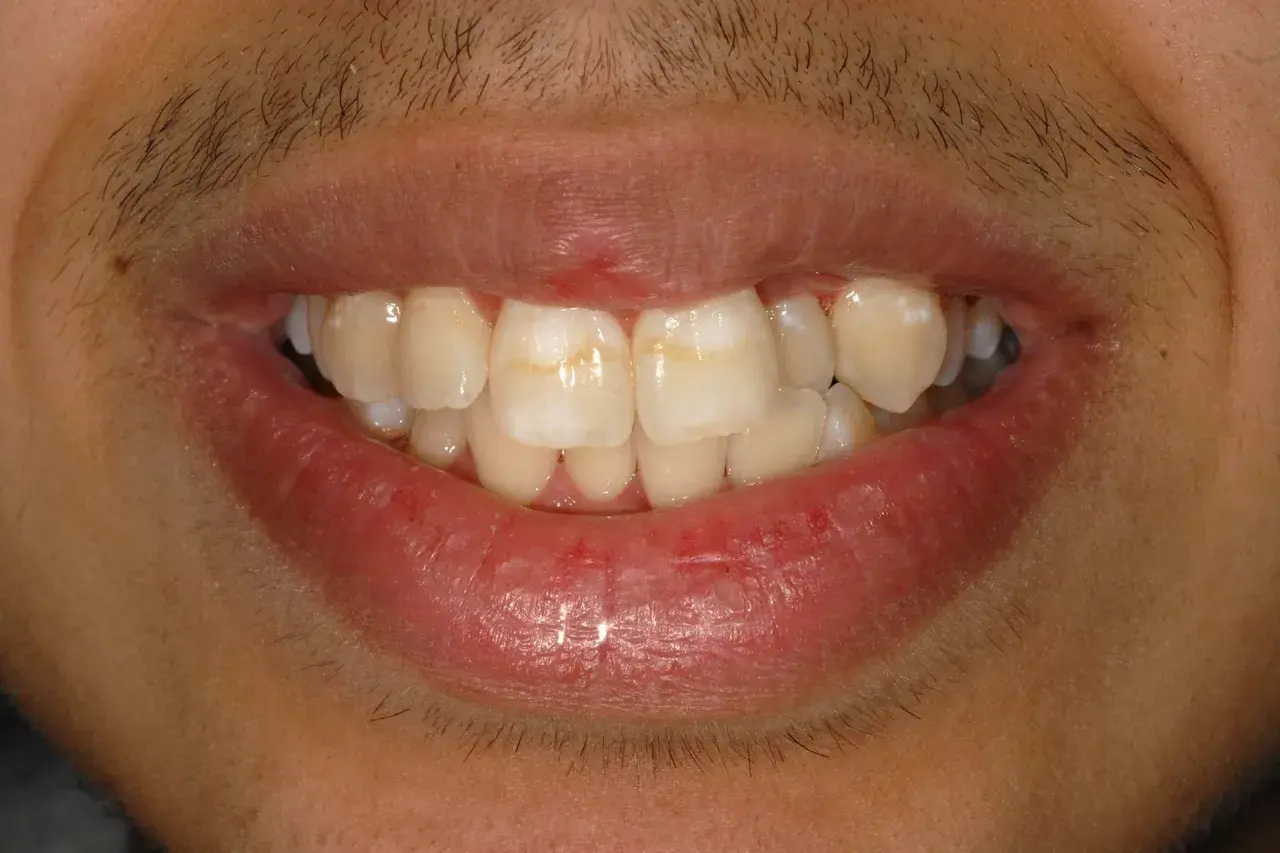 Denti con macchie bianche, possibili segni di carie iniziale.