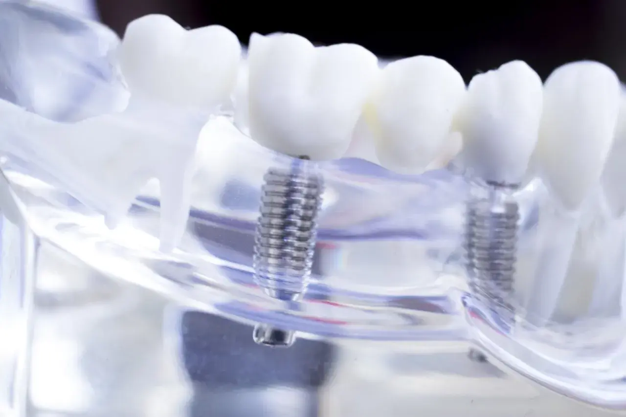 Model szczęki z implantami zębowymi. Sprawdź, czy przysługuje Ci dofinansowanie do implantów zębowych.