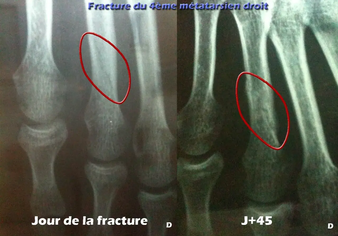 Radiographie du pied montrant une fracture du 4ème métatarsien droit, jour de la fracture et J+45. La guérison prend du temps.