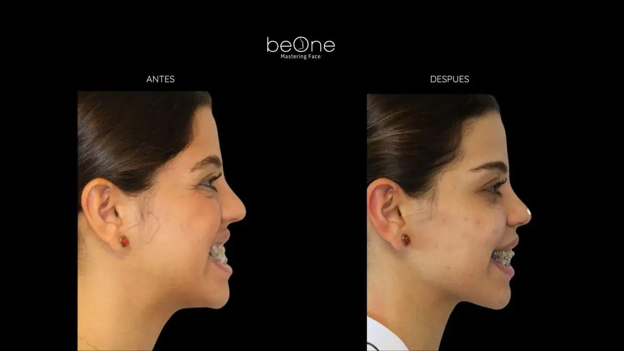Perfil de una mujer antes y después de usar brackets. La imagen muestra la evolución de su cara y labios.