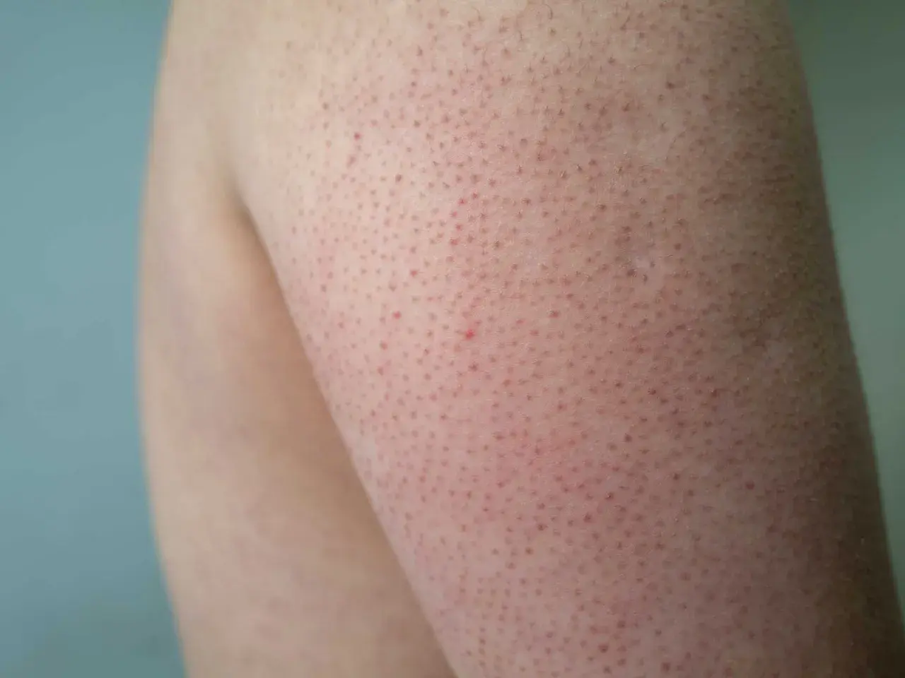 Närbild på knottriga ben med små röda prickar. Huden ser lite irriterad ut.