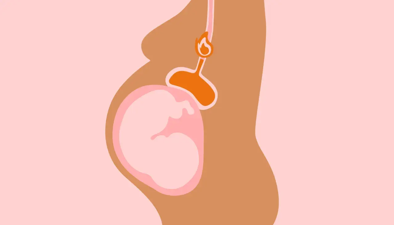Illustration d'une femme enceinte montrant le bébé et l'estomac, avec une flamme symbolisant le **remonter acide grossesse**.