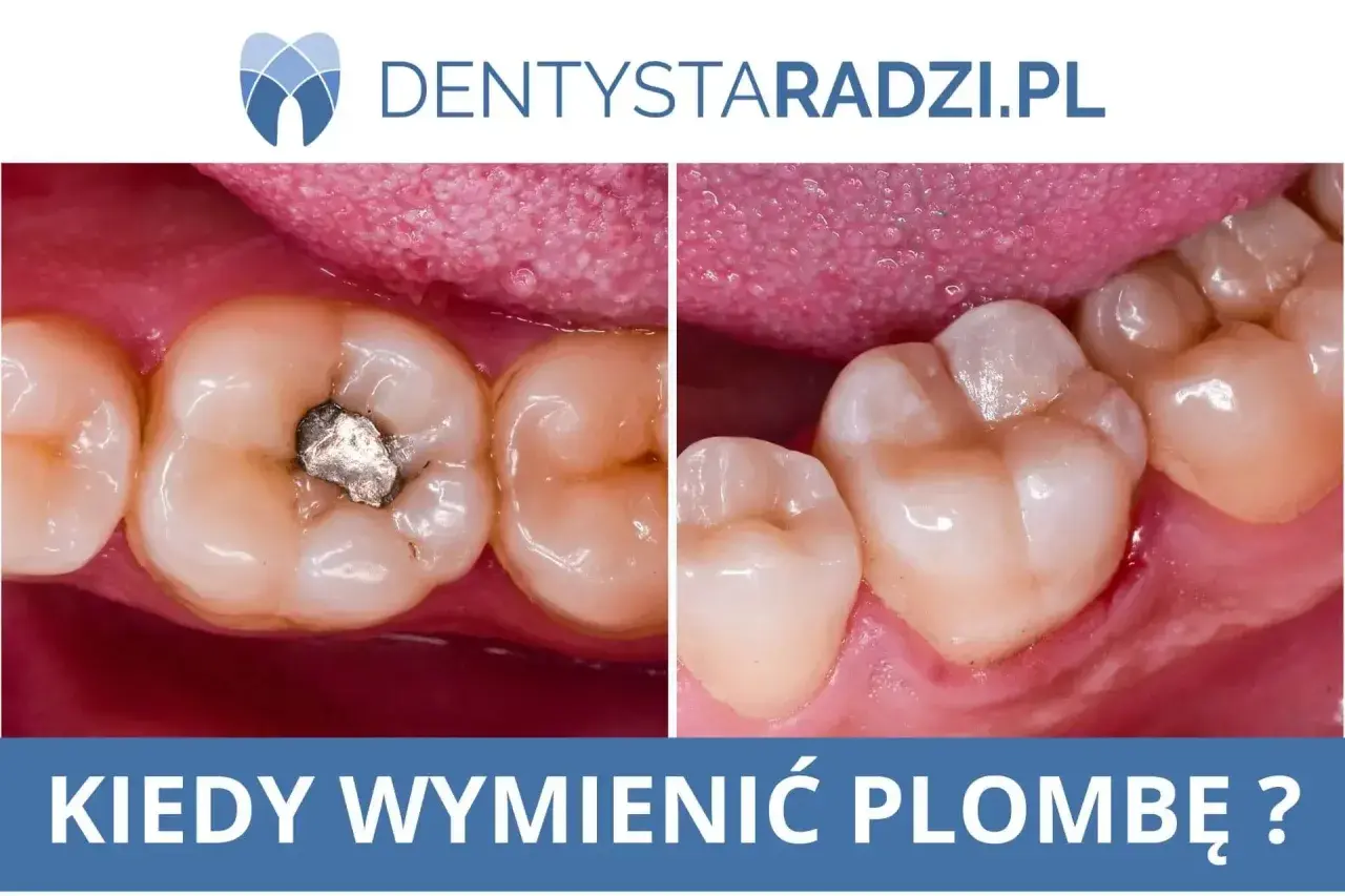 Porównanie zęba z amalgamatową plombą i zęba po wymianie na nową, estetyczną. Kiedy wymienić starą plombę?
