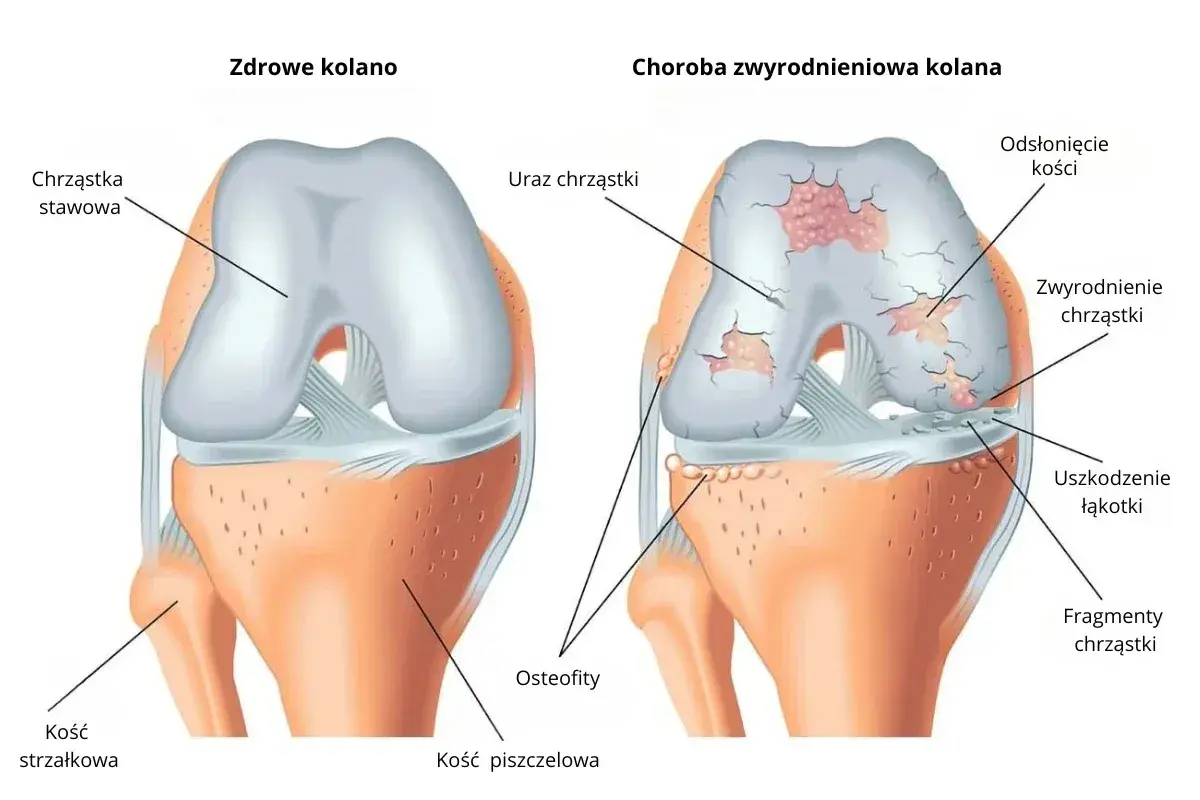 Porównanie zdrowego kolana z kolanem ze zwyrodnieniem, pokazujące uszkodzenia chrząstki i kości.