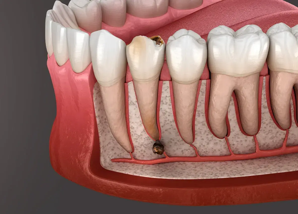 Corte transversal de una muela con caries avanzada y absceso. La infección se extiende a la raíz, mostrando las posibles consecuencias de no extraer una muela con infección.