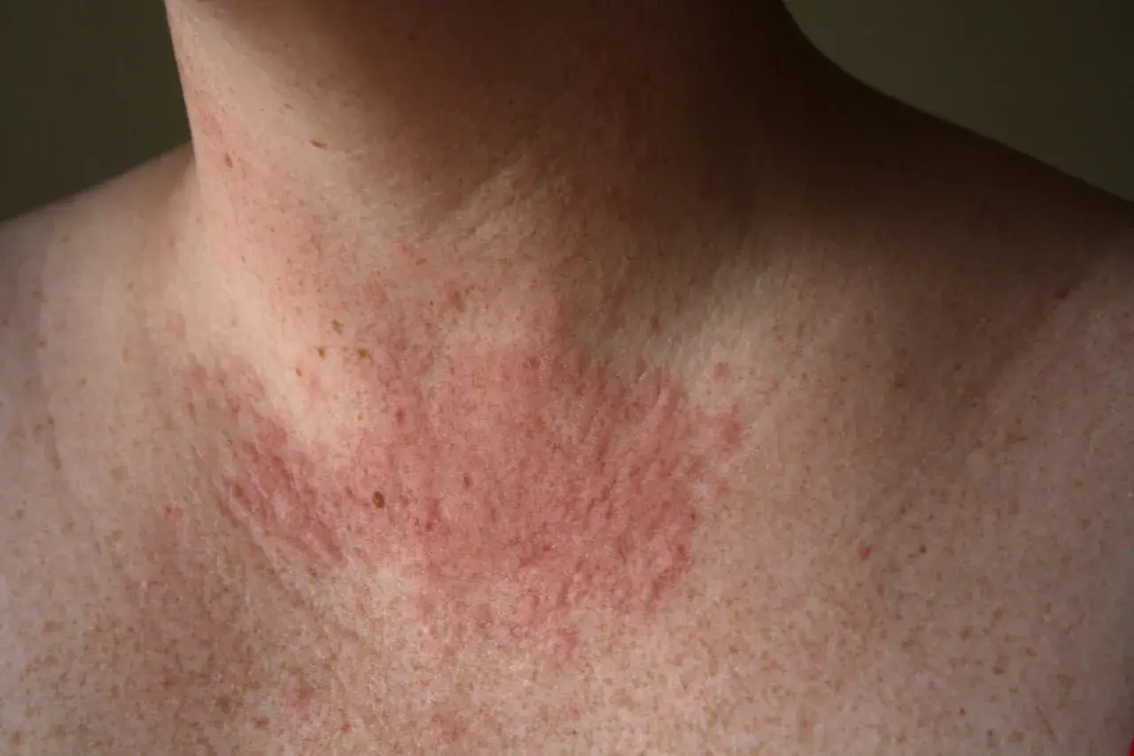 Piel enrojecida y con erupciones en el cuello y pecho, indicativo de una posible alergia al sol.