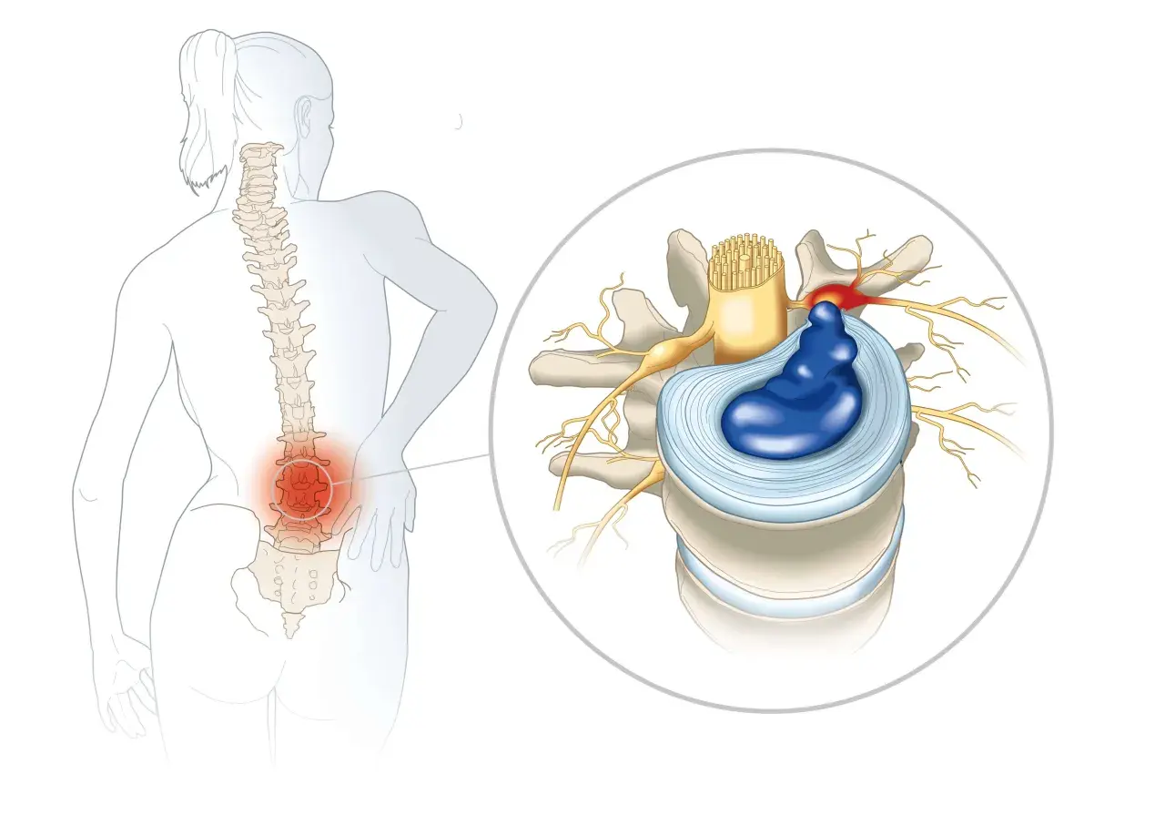 Illustration d'une discopathie lombaire causant une douleur la nuit, avec un disque intervertébral hernié comprimant un nerf.