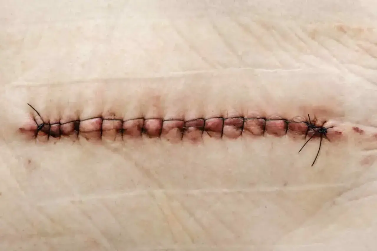 Gros plan d'une plaie suturée, où un fil de suture reste dans la plaie, témoignant du processus de guérison.