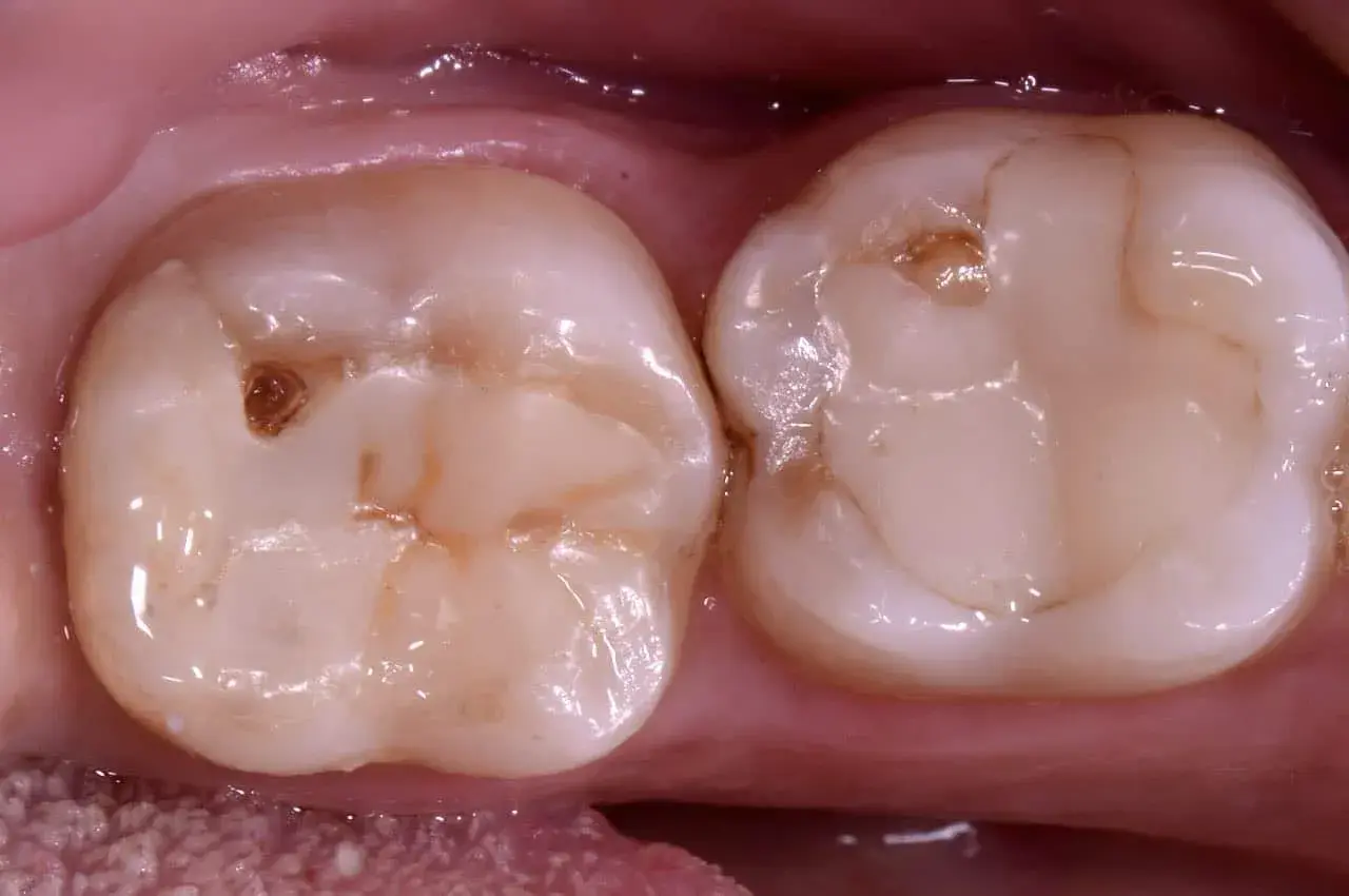 Due denti con un piccolo buco nel dente senza carie, forse un segno di usura o un'antica otturazione.