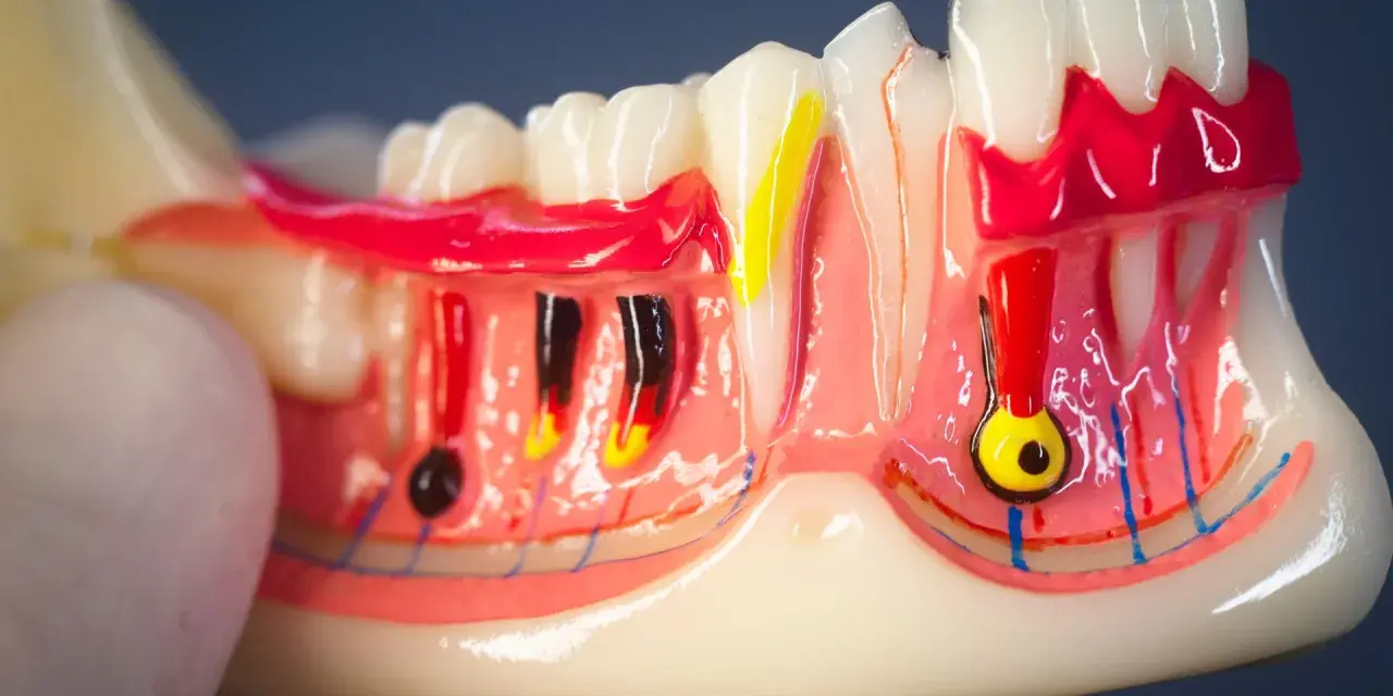 Modello anatomico di denti e gengive, con evidenziati nervi e vasi sanguigni. Si nota il colletto dentale e la struttura ossea.