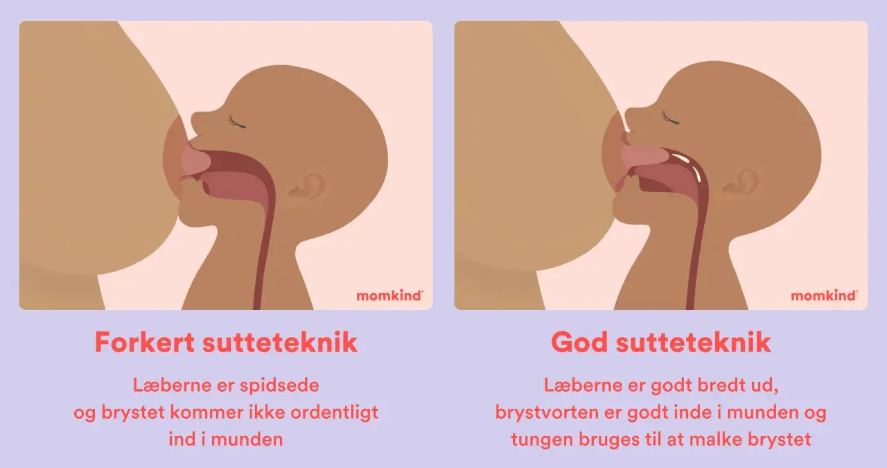 Illustrationer visar fel och rätt amningsteknik. Fel teknik: spetsade läppar, kort tungband kan hindra. Rätt teknik: breda läppar, bröstvårtan djupt inne, tungan mjölkar bröstet.