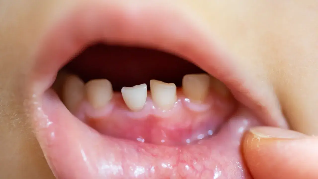 Bocca di bambino con denti da latte spuntati, gengive arrossate. Potrebbe essere la **febbre da dentizione**.