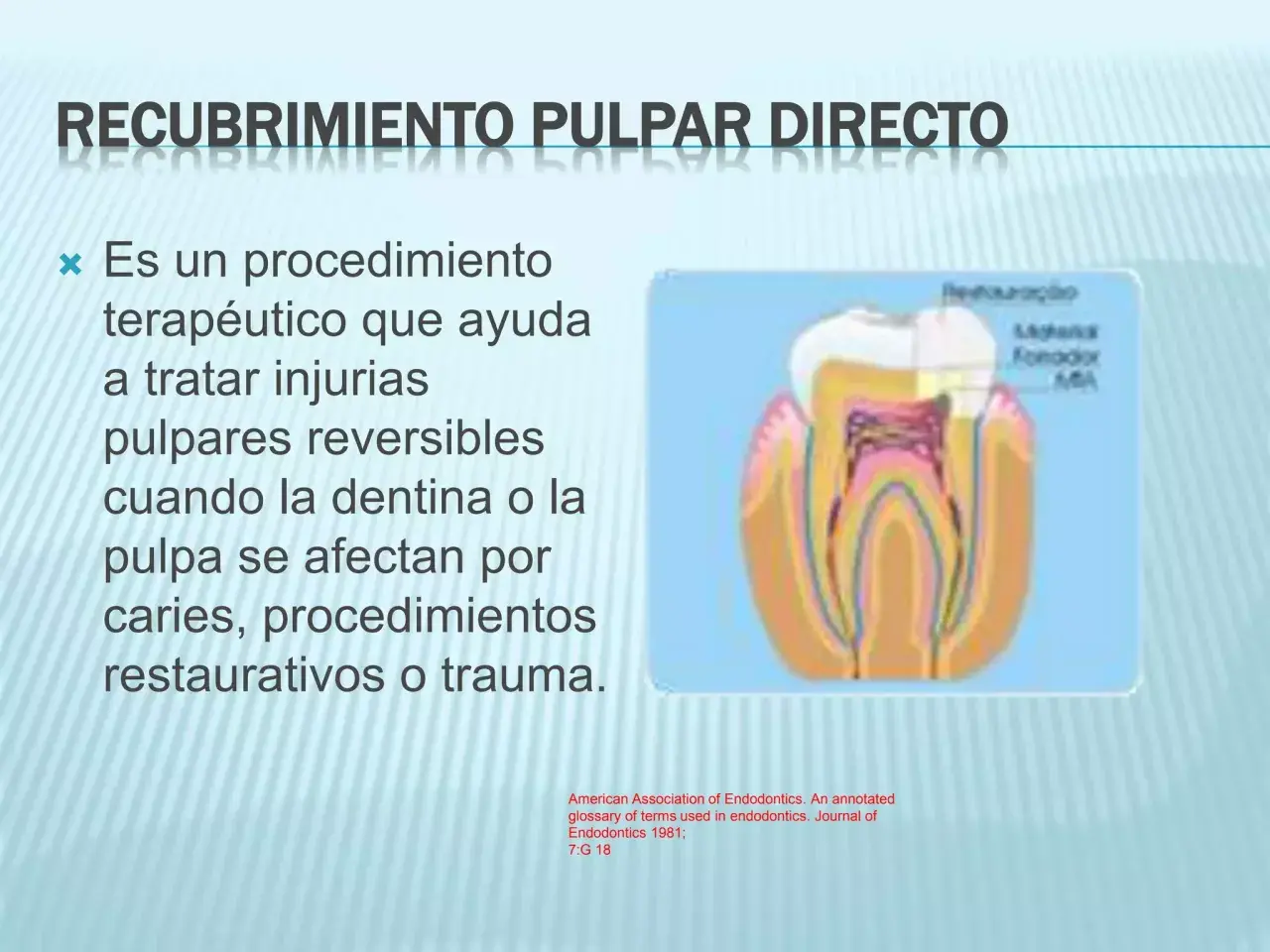 Diagrama de un diente mostrando el recubrimiento pulpar directo, un procedimiento para tratar injurias reversibles en la pulpa dental.