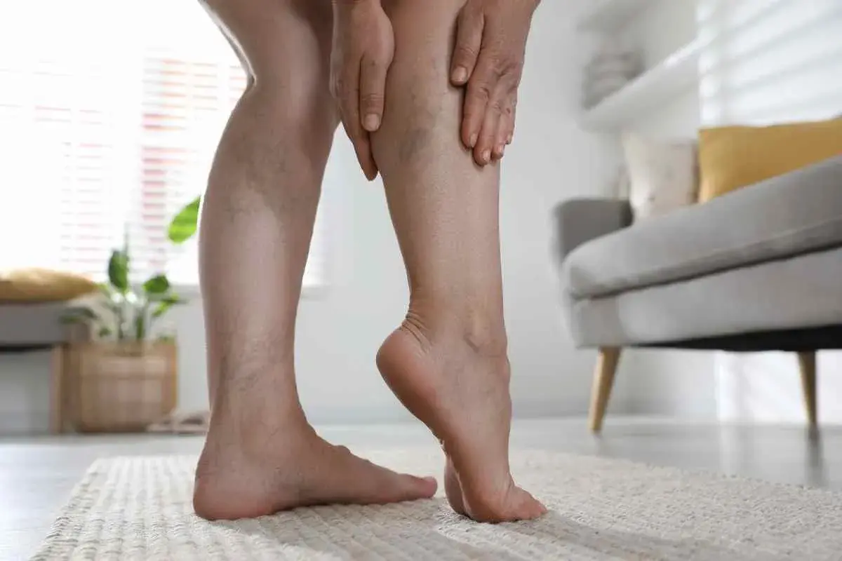 Gambe con vene varicose, che sembrano quasi bloccate, mentre una mano le sfiora con preoccupazione.