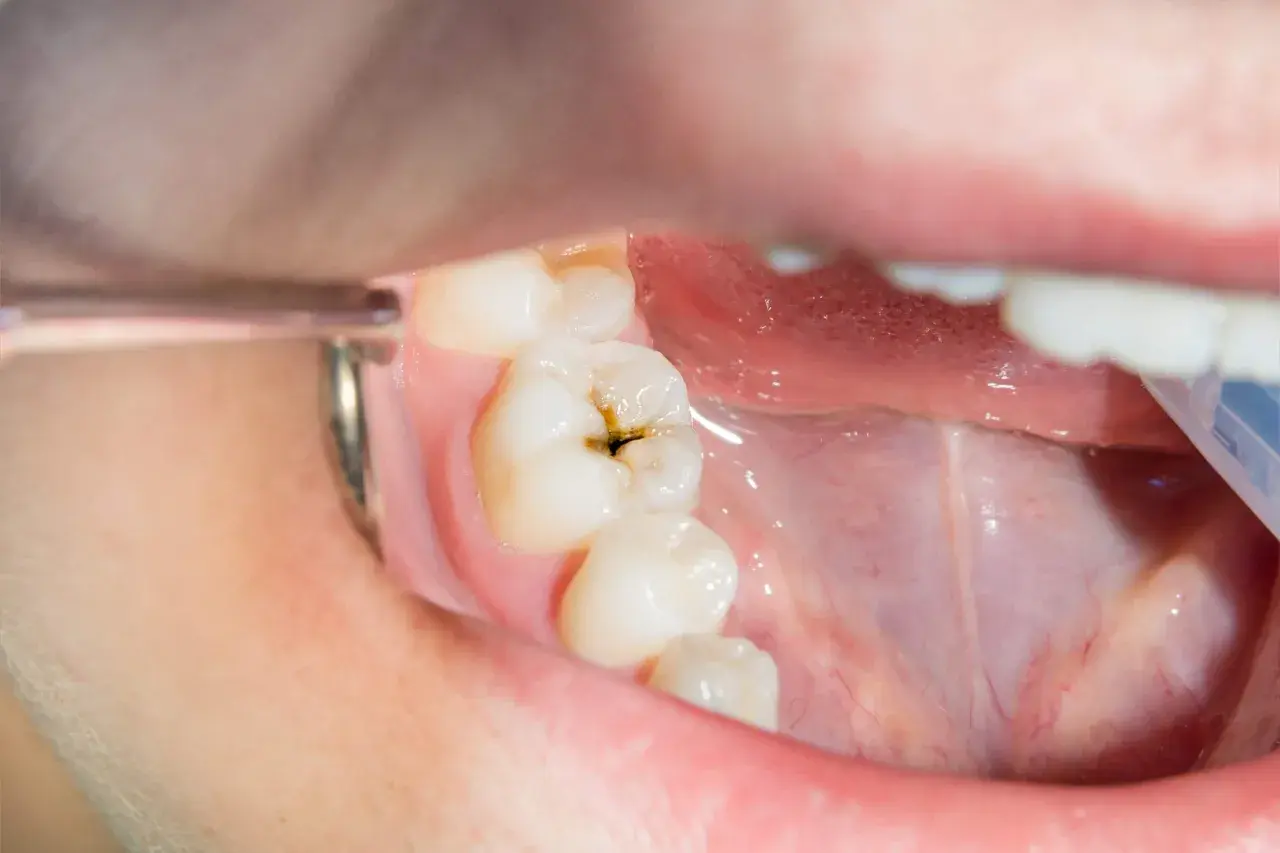 Diente con una cavidad oscura, mostrando por qué salen caries.