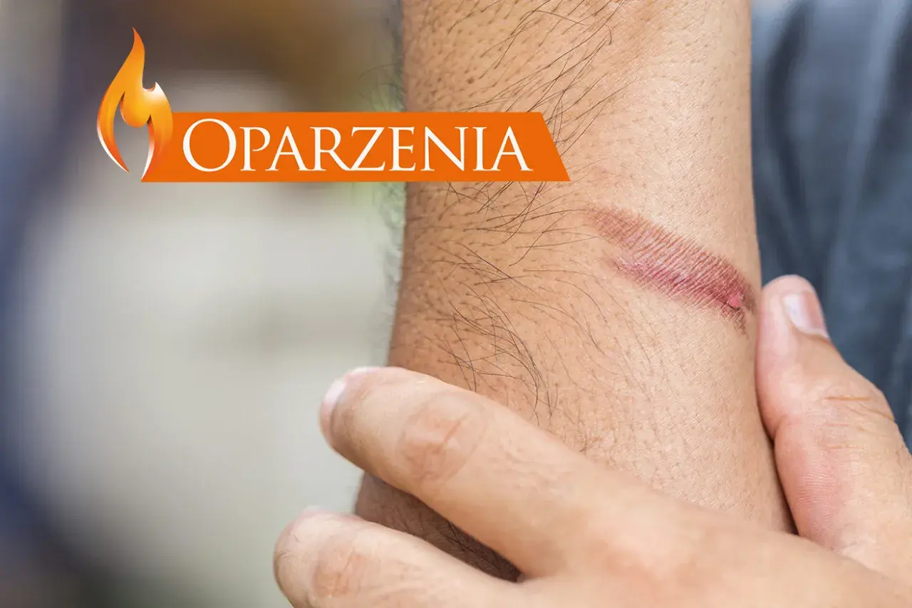 Oparzenia na skórze. Dowiedz się, jak udzielić pierwszej pomocy przy oparzeniach, aby zminimalizować szkody.