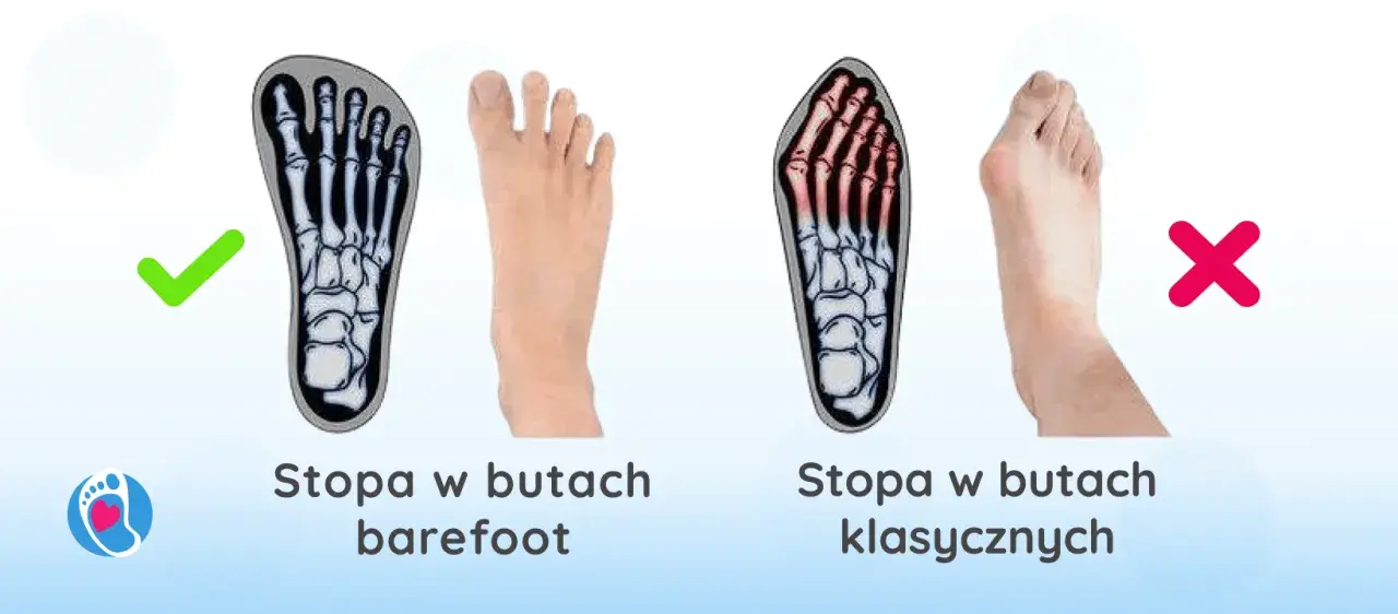 Haluksy: Geny czy buty? Odkryj prawdziwe przyczyny deformacji