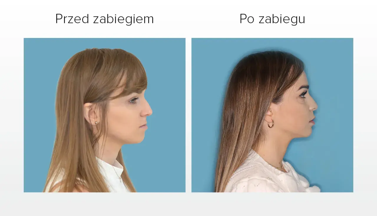 Przed i po zabiegu korekty profilu. Widoczna poprawa linii żuchwy, która wcześniej była lekko krzywa.