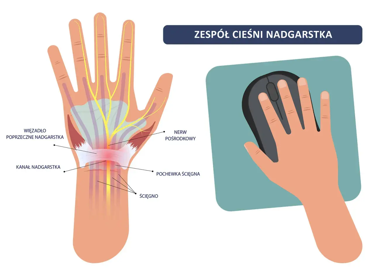 Anatomia cieśni nadgarstka i dłoń trzymająca myszkę. Ilustracja pokazuje ucisk na nerw pośrodkowy, który może prowadzić do bólu i drętwienia, a także do konieczności ubiegania się o odszkodowanie po operacji cieśni nadgarstka.