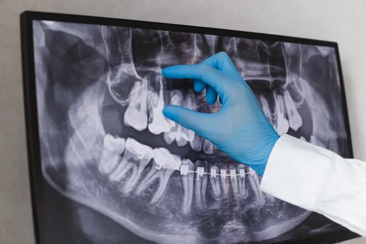 Dentysta w niebieskiej rękawiczce wskazuje na zdjęcie RTG zębów, analizując sytuację przed powtórnym leczeniem kanałowym.