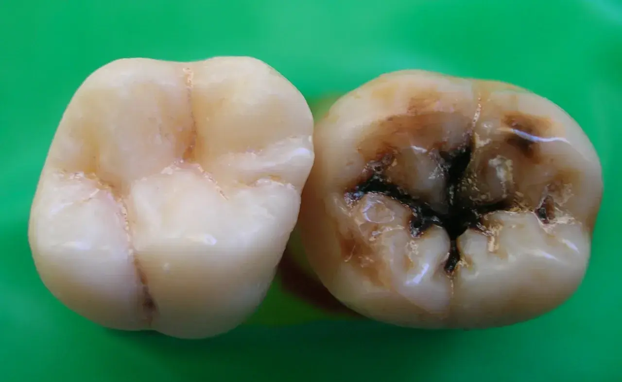 Un diente sano junto a otro con caries avanzadas, oscuras y profundas. Las caries duelen y arruinan la sonrisa.