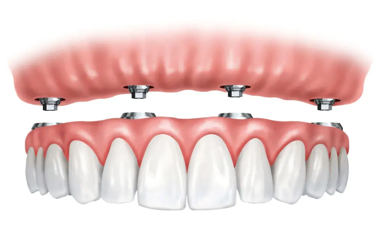 Arcata dentale superiore con impianti dentali. La protesi superiore si aggancia a quattro pilastri metallici.