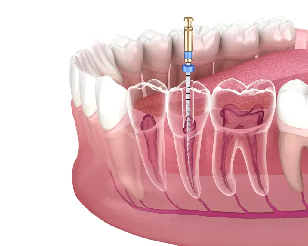 Jak bezpiecznie usunąć ząb? Kiedy dentysta, a kiedy domowe sposoby?
