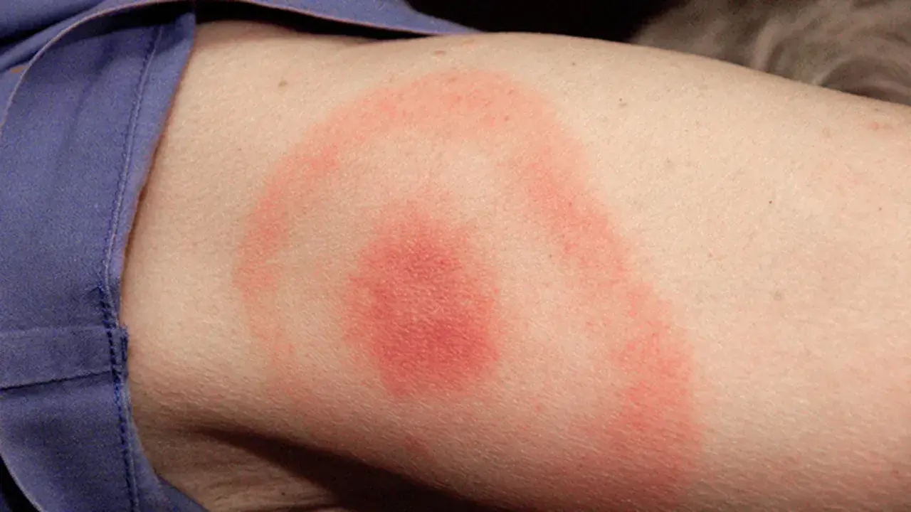 Erupción circular roja en la piel, indicativa de una picadura de garrapata en un humano.